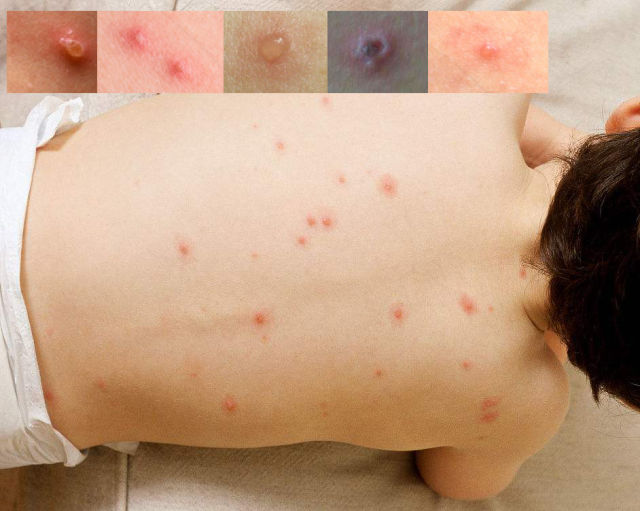 儿童水痘的症状和图片图片